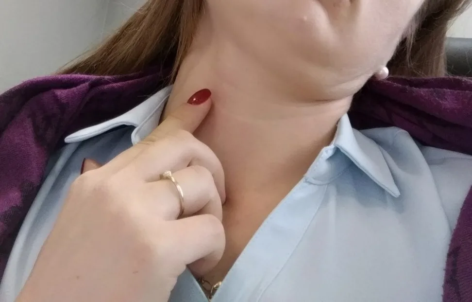Удаление кисты шеи: показания, как проходит операция и реабилитация